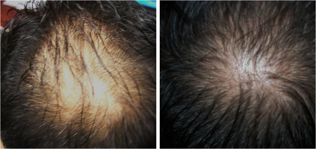 Carboxytherapy treatment for alopecia