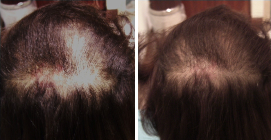 Carboxytherapy treatment for alopecia