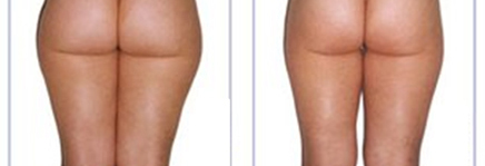 carboxitherapy for cellulite