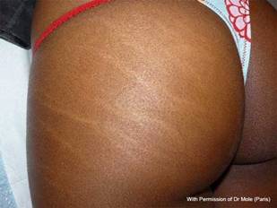 Stretch marks before carboxytherapy