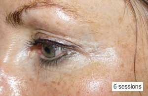 Eye Rejuvenation and Carboxytherapy -  Eye Lids and Dark circles after 6 sessions. Weekly spaced