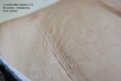Stretch marks 1 month after session 2