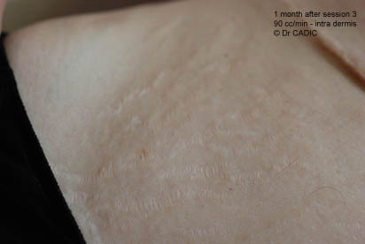 Stretch marks 1 month after session 3