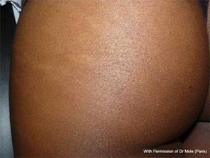 Stretch marks after intradermis CO2 injections