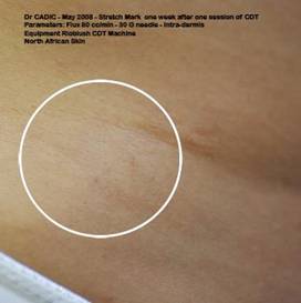 stretch mark after 1 session of carboxytherapy